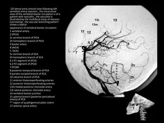 -2D lateral early arteiral view following left
vertebral artery injection , the intracranial
view of the vertebral basilar circulation is of a
patient with vasculitis , the vasculitis is
illustrated by the multifocal areas of stenosis
(narrowing) , the vascular branching pattern
shows a typical
appearance of vertebral basilar circulation
1 vertebral artery
2 (PICA)
2v vermian branch of PICA
2h hemispheric branch of PICA
3 basilar artery
4 (AICA)
5 (SCA)
5v vermian branch of SCA
5h hemispheric branch of SCA
6.1 P1 segment of (PCA)
6.2 P2 segment of (PCA)
7 PCOM
8 posterior temporal branch of PCA
9 parieto-occipital branch of PCA
10 calcarine branch of PCA
11 anterior thalamoperforating arteries
12 posterior thalamoperforating arteries
13m medial posterior choroidal artery
13L lateral posterior choroidal artery
14 vertebral basilar junction
15 splenial branch (posterior pericallosal
artery) of PCA
** region of quadrigeminal plate cistern
17 anterior spinal artery
 