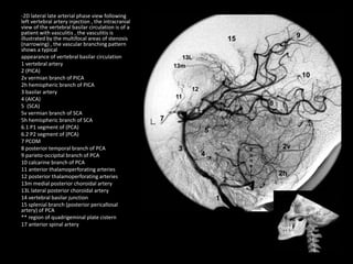 -2D lateral late arterial phase view following
left vertebral artery injection , the intracranial
view of the vertebral basilar circulation is of a
patient with vasculitis , the vasculitis is
illustrated by the multifocal areas of stenosis
(narrowing) , the vascular branching pattern
shows a typical
appearance of vertebral basilar circulation
1 vertebral artery
2 (PICA)
2v vermian branch of PICA
2h hemispheric branch of PICA
3 basilar artery
4 (AICA)
5 (SCA)
5v vermian branch of SCA
5h hemispheric branch of SCA
6.1 P1 segment of (PCA)
6.2 P2 segment of (PCA)
7 PCOM
8 posterior temporal branch of PCA
9 parieto-occipital branch of PCA
10 calcarine branch of PCA
11 anterior thalamoperforating arteries
12 posterior thalamoperforating arteries
13m medial posterior choroidal artery
13L lateral posterior choroidal artery
14 vertebral basilar junction
15 splenial branch (posterior pericallosal
artery) of PCA
** region of quadrigeminal plate cistern
17 anterior spinal artery
 