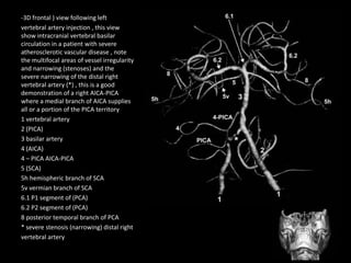 -3D frontal ) view following left
vertebral artery injection , this view
show intracranial vertebral basilar
circulation in a patient with severe
atherosclerotic vascular disease , note
the multifocal areas of vessel irregularity
and narrowing (stenoses) and the
severe narrowing of the distal right
vertebral artery (*) , this is a good
demonstration of a right AICA-PICA
where a medial branch of AICA supplies
all or a portion of the PICA territory
1 vertebral artery
2 (PICA)
3 basilar artery
4 (AICA)
4 – PICA AICA-PICA
5 (SCA)
5h hemispheric branch of SCA
5v vermian branch of SCA
6.1 P1 segment of (PCA)
6.2 P2 segment of (PCA)
8 posterior temporal branch of PCA
* severe stenosis (narrowing) distal right
vertebral artery
 