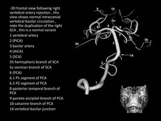 -3D frontal view following right
vertebral artery injection , this
view shows normal intracranial
vertebral basilar circulation ,
note the duplication of the right
SCA , this is a normal variant
1 vertebral artery
2 (PICA)
3 basilar artery
4 (AICA)
5 (SCA)
5h hemispheric branch of SCA
5v vermian branch of SCA
6 (PCA)
6.1 P1 segment of PCA
6.2 P2 segment of PCA
8 posterior temporal branch of
PCA
9 parieto-occipital branch of PCA
10 calcarine branch of PCA
14 vertebral basilar junction
 