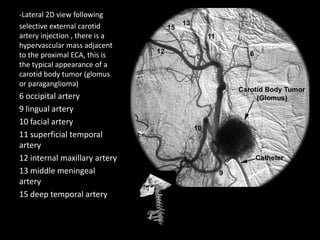 -Lateral 2D view following
selective external carotid
artery injection , there is a
hypervascular mass adjacent
to the proximal ECA, this is
the typical appearance of a
carotid body tumor (glomus
or paraganglioma)
6 occipital artery
9 lingual artery
10 facial artery
11 superficial temporal
artery
12 internal maxillary artery
13 middle meningeal
artery
15 deep temporal artery
 