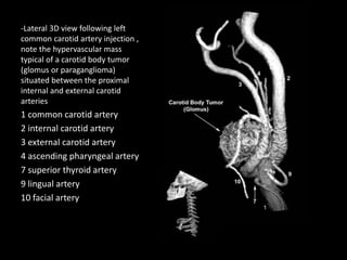 -Lateral 3D view following left
common carotid artery injection ,
note the hypervascular mass
typical of a carotid body tumor
(glomus or paraganglioma)
situated between the proximal
internal and external carotid
arteries
1 common carotid artery
2 internal carotid artery
3 external carotid artery
4 ascending pharyngeal artery
7 superior thyroid artery
9 lingual artery
10 facial artery
 