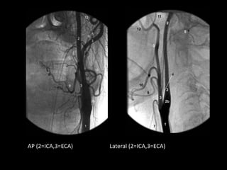 AP (2=ICA,3=ECA) Lateral (2=ICA,3=ECA)
 