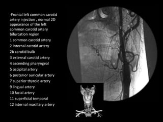-Frontal left common carotid
artery injection , normal 2D
appearance of the left
common carotid artery
bifurcation region
1 common carotid artery
2 internal carotid artery
2b carotid bulb
3 external carotid artery
4 ascending pharyngeal
5 occipital artery
6 posterior auricular artery
7 superior thyroid artery
9 lingual artery
10 facial artery
11 superficial temporal
12 internal maxillary artery
 