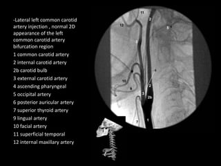 -Lateral left common carotid
artery injection , normal 2D
appearance of the left
common carotid artery
bifurcation region
1 common carotid artery
2 internal carotid artery
2b carotid bulb
3 external carotid artery
4 ascending pharyngeal
5 occipital artery
6 posterior auricular artery
7 superior thyroid artery
9 lingual artery
10 facial artery
11 superficial temporal
12 internal maxillary artery
 