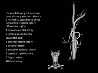 -Frontal following left common
carotid artery injection , there is
a normal 3D appearance of the
left common carotid artery
bifurcation region
1 common carotid artery
2 internal carotid artery
2b carotid bulb
3 external carotid artery
5 occipital artery
6 posterior auricular artery
7 superior thyroid artery
9 lingual artery
10 facial artery
 