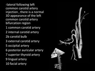 -lateral following left
common carotid artery
injection , there is a normal
3D appearance of the left
common carotid artery
bifurcation region
1 common carotid artery
2 internal carotid artery
2b carotid bulb
3 external carotid artery
5 occipital artery
6 posterior auricular artery
7 superior thyroid artery
9 lingual artery
10 facial artery
 