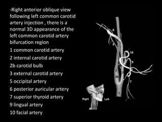 -Right anterior oblique view
following left common carotid
artery injection , there is a
normal 3D appearance of the
left common carotid artery
bifurcation region
1 common carotid artery
2 internal carotid artery
2b carotid bulb
3 external carotid artery
5 occipital artery
6 posterior auricular artery
7 superior thyroid artery
9 lingual artery
10 facial artery
 