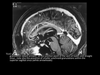 T1+C shows a large CSF-isointense filling defect , consistent with an arachnoid
granulation (black arrows) , at the junction point of the vein of Galen and straight
sinus , note also the presence of smaller arachnoid granulations within the
superior sagittal sinus (white arrowheads)
 