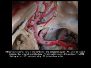 Intracranial superior view of the right sellar and parasellar region , AC: anterior clinoid
process , ICA: internal carotid artery , LT: lamina terminalis , ON: optic nerve , OlN:
olfatory nerve , SW: sphenoid wing , TS: tubercullum sellae
 