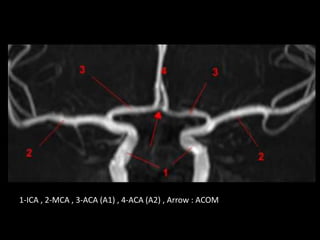 1-ICA , 2-MCA , 3-ACA (A1) , 4-ACA (A2) , Arrow : ACOM
 