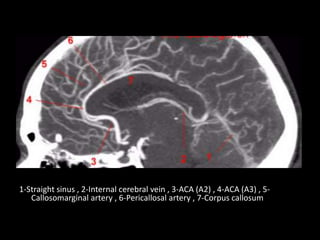 1-Straight sinus , 2-Internal cerebral vein , 3-ACA (A2) , 4-ACA (A3) , 5-
Callosomarginal artery , 6-Pericallosal artery , 7-Corpus callosum
 