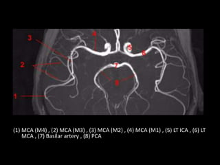 (1) MCA (M4) , (2) MCA (M3) , (3) MCA (M2) , (4) MCA (M1) , (5) LT ICA , (6) LT
MCA , (7) Basilar artery , (8) PCA
 