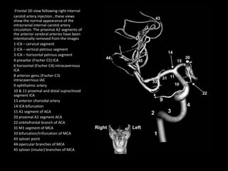 -Frontal 3D view following right internal
carotid artery injection , these views
show the normal appearance of the
intracranial internal carotid artery
circulation. The proximal A2 segments of
the anterior cerebral arteries have been
intentionally removed from the images
1 ICA – cervical segment
2 ICA – vertical petrous segment
3 ICA – horizontal petrous segment
4 presellar (Fischer C5) ICA
6 horizontal (Fischer C4) intracavernous
ICA
8 anterior genu (Fischer C3)
intracavernous IAC
9 ophthalmic artery
10 & 11 proximal and distal supraclinoid
segment ICA
13 anterior choroidal artery
14 ICA bifurcation
15 A1 segment of ACA
20 proximal A2 segment ACA
22 orbitofrontal branch of ACA
31 M1 segment of MCA
33 bifurcation/trifurcation of MCA
43 sylvian point
44 opercular branches of MCA
45 sylvian (insular) branches of MCA
 