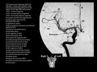 -2D frontal view following right ICA
injection , these views show a small
aneurysm projecting inferiorly in the
region of the right MCA bifurcation
1 ICA – cervical segment
2 ICA – vertical petrous segment
3 ICA – horizontal petrous segment
4 presellar (Fischer C5) segment ICA
8 anterior genu (Fischer C3)
intracavernous ICA
9 ophthalmic artery
10 & 11 proximal and distal supraclinoid
segments ICA
13 anterior choroidal artery
14 ICA bifurcation
15 A1 segment of ACA
18 A1-A2 junction ACA
20 proximal A2 segment ACA
21 callosomarginal branch of ACA
22 orbitofrontal branch of ACA
23 frontopolar branch of ACA
28 pericallosal branch of ACA
31 M1 segment of MCA
32 lateral lenticulostriate arteries
33 bifurcation/trifurcation of MCA
35 orbitofrontal branch of MCA
43 sylvian point
44 opercular branches MCA
45 sylvian (insular) branches of MCA
An aneurysm
 