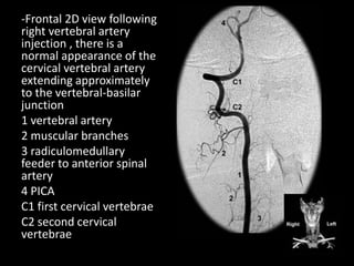 -Frontal 2D view following
right vertebral artery
injection , there is a
normal appearance of the
cervical vertebral artery
extending approximately
to the vertebral-basilar
junction
1 vertebral artery
2 muscular branches
3 radiculomedullary
feeder to anterior spinal
artery
4 PICA
C1 first cervical vertebrae
C2 second cervical
vertebrae
 