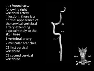 -3D frontal view
following right
vertebral artery
injection , there is a
normal appearance of
the cervical vertebral
artery extending
approximately to the
skull base
1 vertebral artery
2 muscular branches
C1 first cervical
vertebrae
C2 second cervical
vertebrae
 