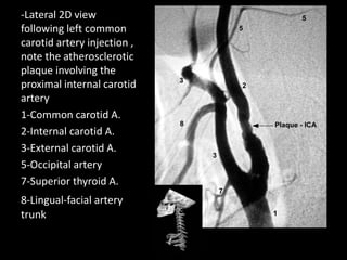 -Lateral 2D view
following left common
carotid artery injection ,
note the atherosclerotic
plaque involving the
proximal internal carotid
artery
1-Common carotid A.
2-Internal carotid A.
3-External carotid A.
5-Occipital artery
7-Superior thyroid A.
8-Lingual-facial artery
trunk
 