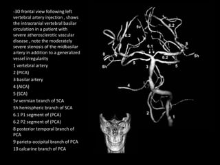 -3D frontal view following left
vertebral artery injection , shows
the intracranial vertebral basilar
circulation in a patient with
severe atherosclerotic vascular
disease , note the moderately
severe stenosis of the midbasilar
artery in addition to a generalized
vessel irregularity
1 vertebral artery
2 (PICA)
3 basilar artery
4 (AICA)
5 (SCA)
5v vermian branch of SCA
5h hemispheric branch of SCA
6.1 P1 segment of (PCA)
6.2 P2 segment of (PCA)
8 posterior temporal branch of
PCA
9 parieto-occipital branch of PCA
10 calcarine branch of PCA
 