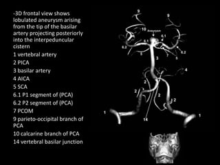 -3D frontal view shows
lobulated aneurysm arising
from the tip of the basilar
artery projecting posteriorly
into the interpeduncular
cistern
1 vertebral artery
2 PICA
3 basilar artery
4 AICA
5 SCA
6.1 P1 segment of (PCA)
6.2 P2 segment of (PCA)
7 PCOM
9 parieto-occipital branch of
PCA
10 calcarine branch of PCA
14 vertebral basilar junction
 