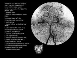 -2D frontal view following vertebral
artery injection , shows normal
intracranial vertebral basilar
circulation , note the blush (*) of the
choroid plexus
1 vertebral artery
2 posterior inferior cerebellar artery
(PICA)
2v vermian branch of PICA
2h hemispheric branch of PICA
3 basilar artery
4 anterior inferior cerebellar artery
(AICA)
5 superior cerebellar artery (SCA)
5h hemispheric branch of SCA
5v vermian branch of SCA
6 posterior cerebral artery (PCA)
6.2 P2 segment of PCA
8 posterior temporal branch of PCA
9 parieto-occipital branch of PCA
10 calcarine branch of PCA
12 posterior thalamoperforating arteries
13L lateral posterior choroidal artery
16 pontine perforating artery
* blush of choroids plexus
 