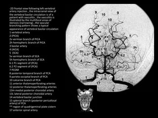 -2D frontal view following left vertebral
artery injection , the intracranial view of
the vertebral basilar circulation is of a
patient with vasculitis , the vasculitis is
illustrated by the multifocal areas of
stenosis (narrowing) , the vascular
branching pattern shows a typical
appearance of vertebral basilar circulation
1 vertebral artery
2 (PICA)
2v vermian branch of PICA
2h hemispheric branch of PICA
3 basilar artery
4 (AICA)
5 (SCA)
5v vermian branch of SCA
5h hemispheric branch of SCA
6.1 P1 segment of (PCA)
6.2 P2 segment of (PCA)
7 PCOM
8 posterior temporal branch of PCA
9 parieto-occipital branch of PCA
10 calcarine branch of PCA
11 anterior thalamoperforating arteries
12 posterior thalamoperforating arteries
13m medial posterior choroidal artery
13L lateral posterior choroidal artery
14 vertebral basilar junction
15 splenial branch (posterior pericallosal
artery) of PCA
** region of quadrigeminal plate cistern
17 anterior spinal artery
 
