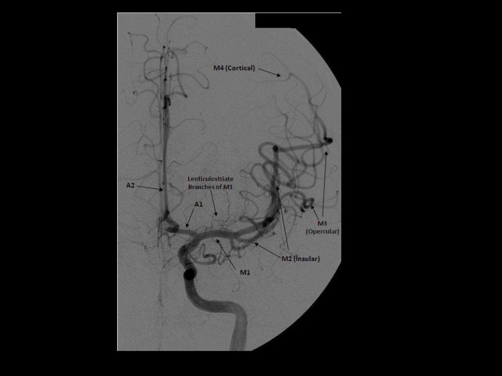 -3D posterior view
following right
vertebral artery
injection , there is a
normal appearance of
the cervical vertebral
art...