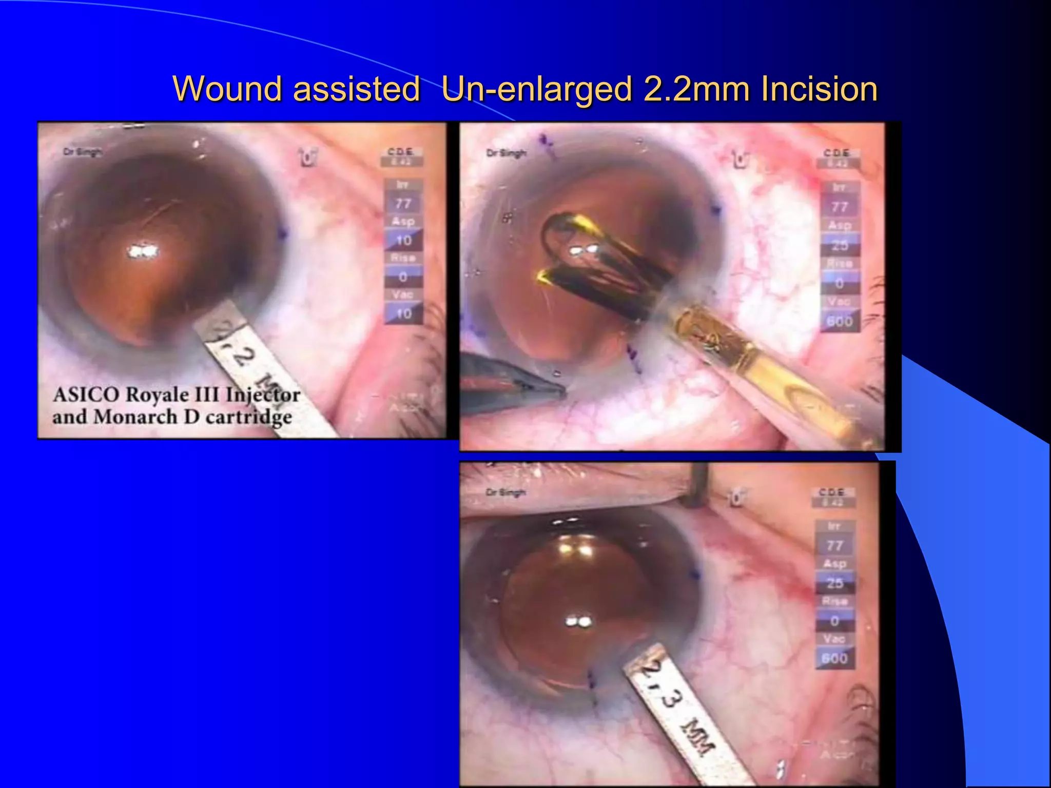 Wound assisted Un-enlarged 2.2mm Incision
 