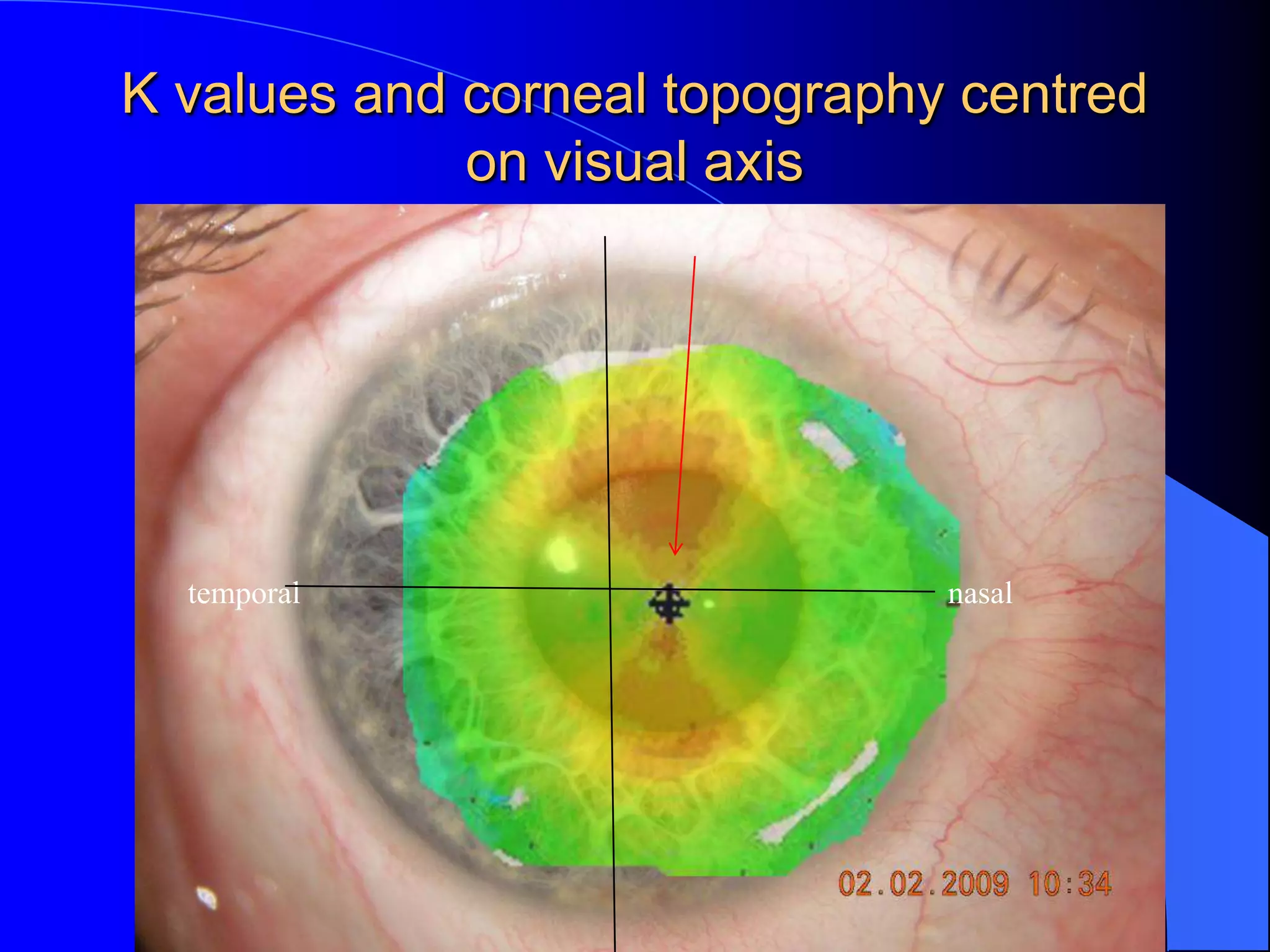 K values and corneal topography centred
on visual axis
nasaltemporal
 