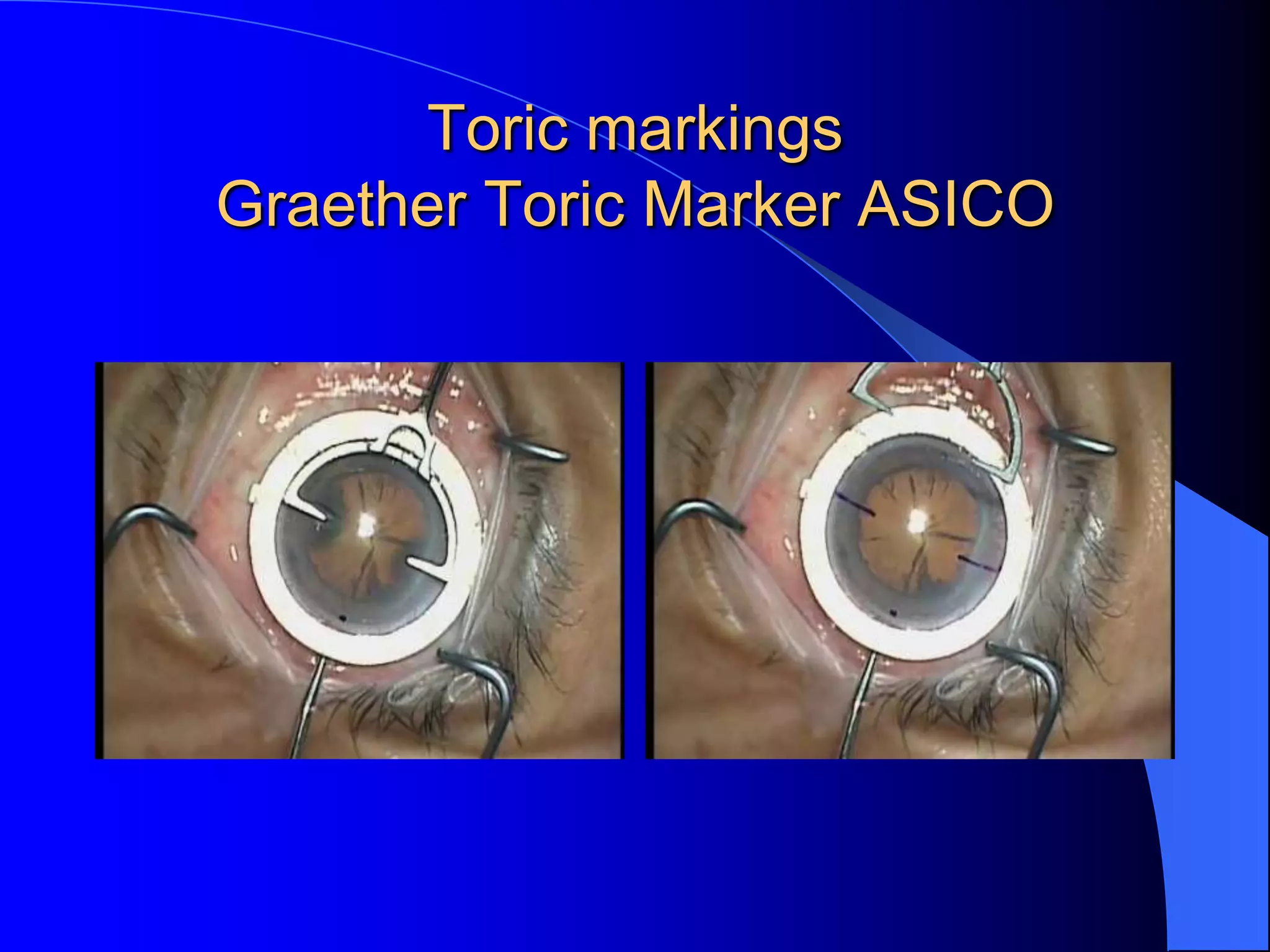 Toric markings
Graether Toric Marker ASICO
 