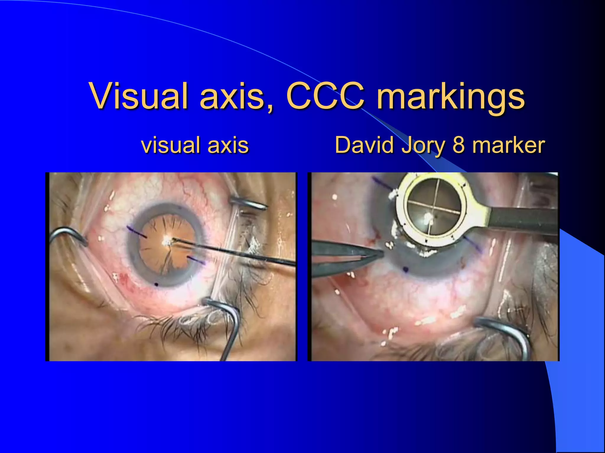 Visual axis, CCC markings
visual axis David Jory 8 marker
 