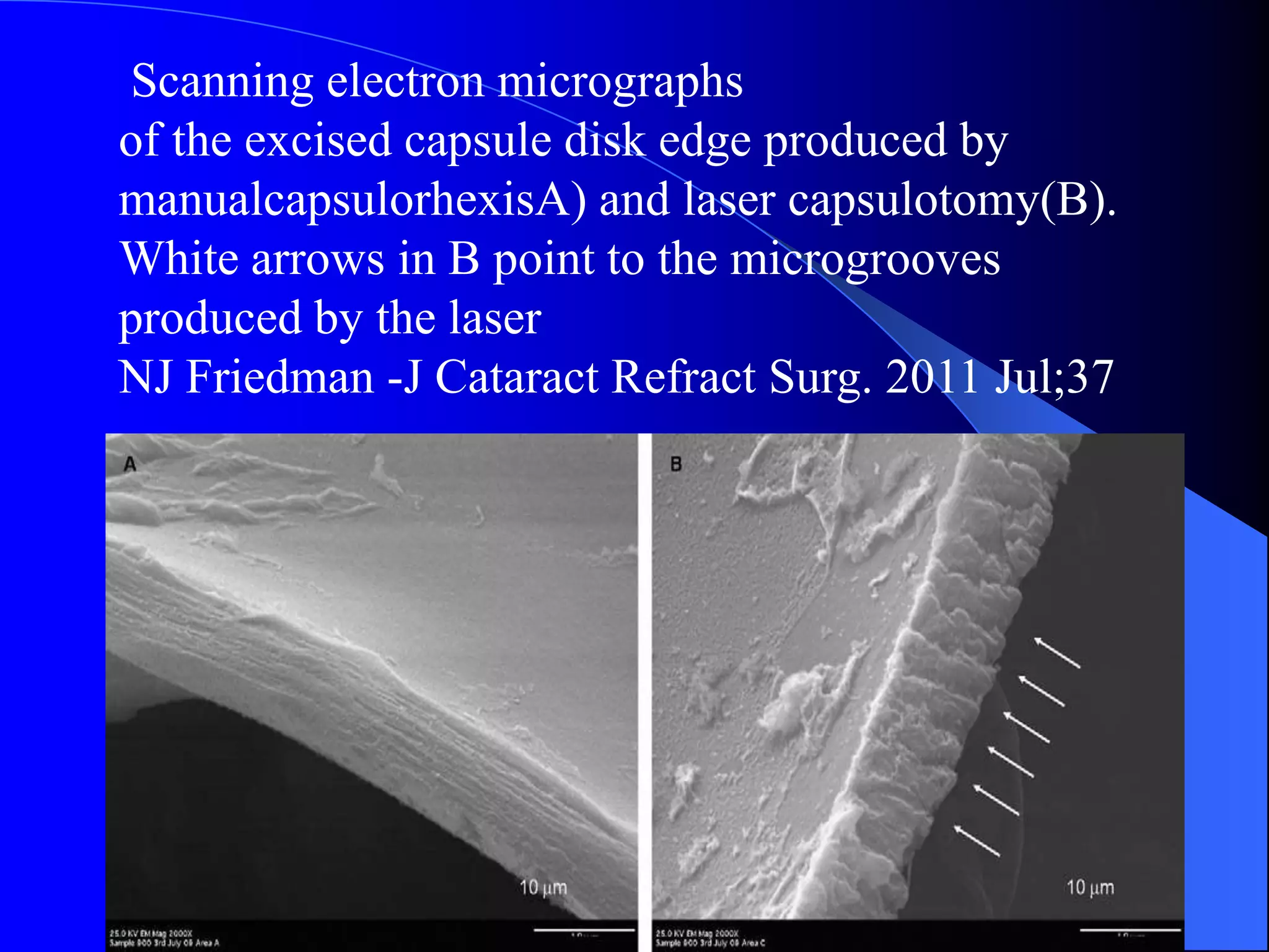 Scanning electron micrographs
of the excised capsule disk edge produced by
manualcapsulorhexisA) and laser capsulotomy(B).
White arrows in B point to the microgrooves
produced by the laser
NJ Friedman -J Cataract Refract Surg. 2011 Jul;37
 