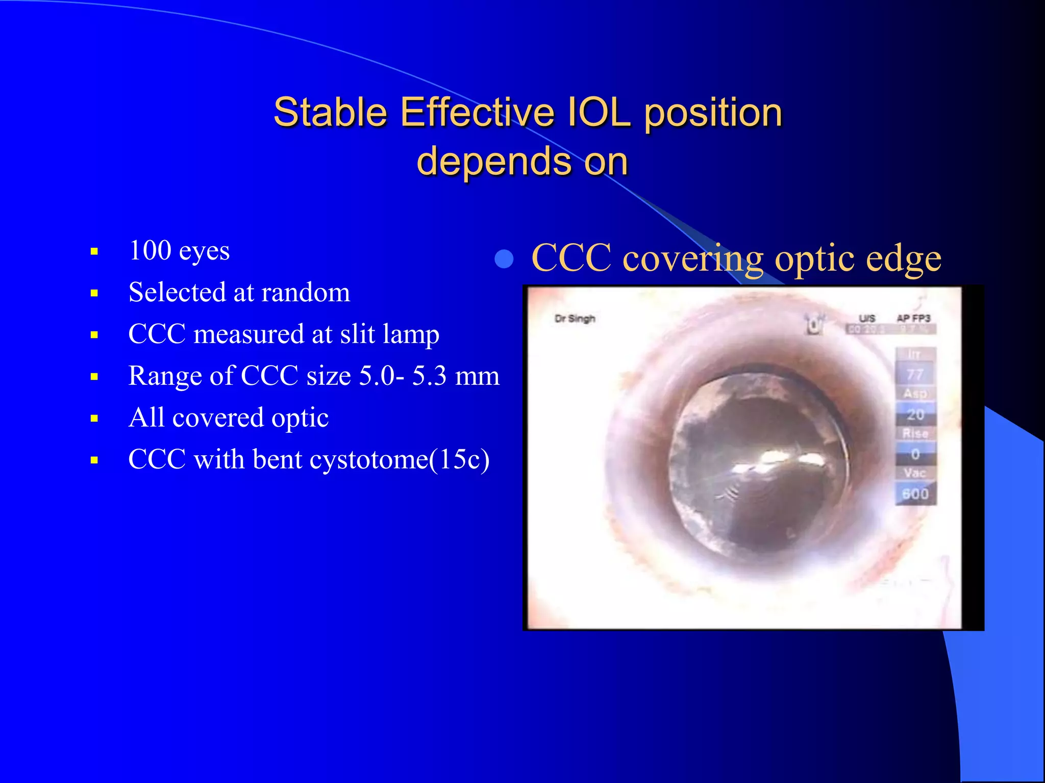 Stable Effective IOL position
depends on
 100 eyes
 Selected at random
 CCC measured at slit lamp
 Range of CCC size 5.0- 5.3 mm
 All covered optic
 CCC with bent cystotome(15c)
 CCC covering optic edge
 