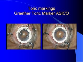 Toric Rgp Markings Premier IOL choices-Technique & Decision Making | PPTX