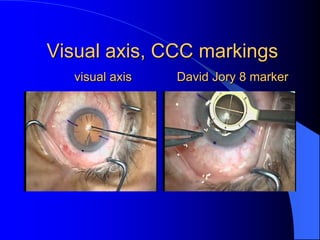 Ccc Visual Premier IOL choices-Technique & Decision Making | PPTX
