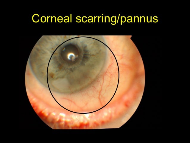 Ocular Oncology Update