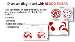 Diseases diagnosed with BLOOD SMEAR
Any conditions in blood which will affect
size ,shape and count of blood cells
such as
• Anemia
• Jaundice
• Sickle cell disease
• Thalassemia
2/20/2024 11
 