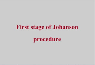 First stage of johanson procedures