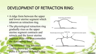 Pathologic Retraction Ring First stage of labor | PPTX