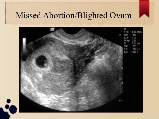 First trimester bleeding