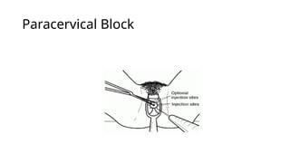 Paracervical Injection first trimester termination of pregnancy.pptx