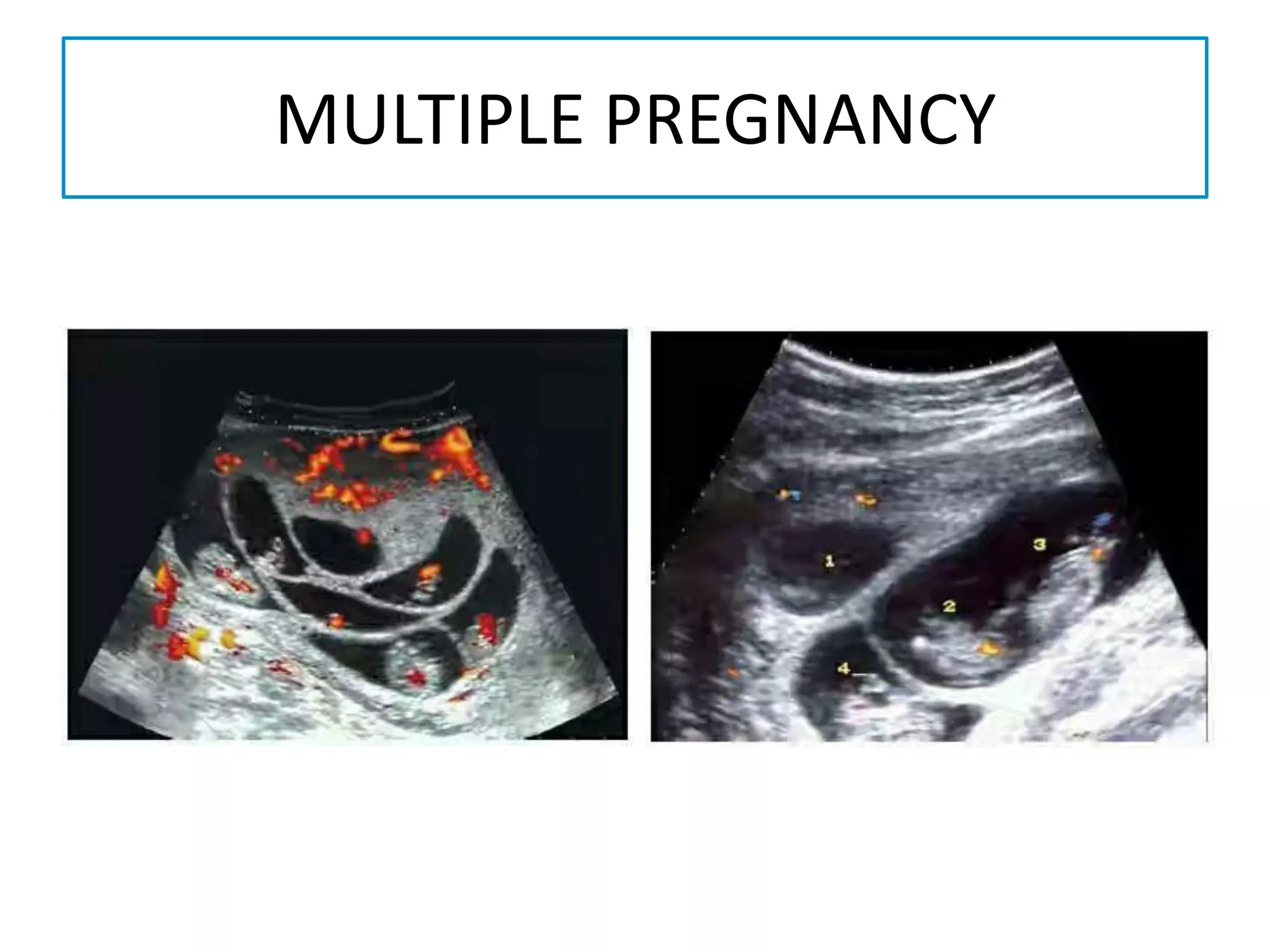First trimester ultrasound | PDF