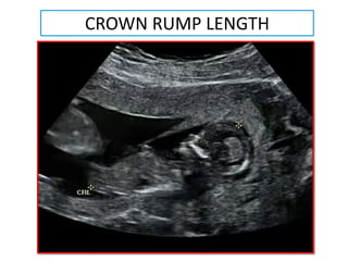 Normal Crown Rump Length First trimester ultrasound | PDF