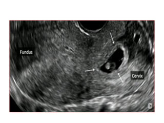Normal first trimester ultrasound