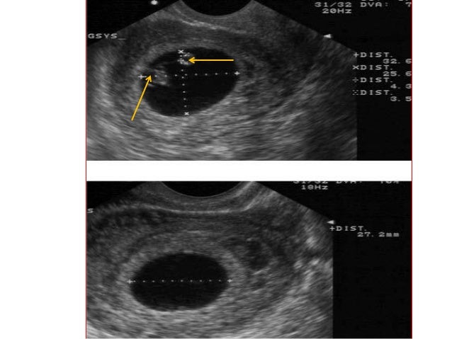Ultrasound dating accuracy 13 weeks
