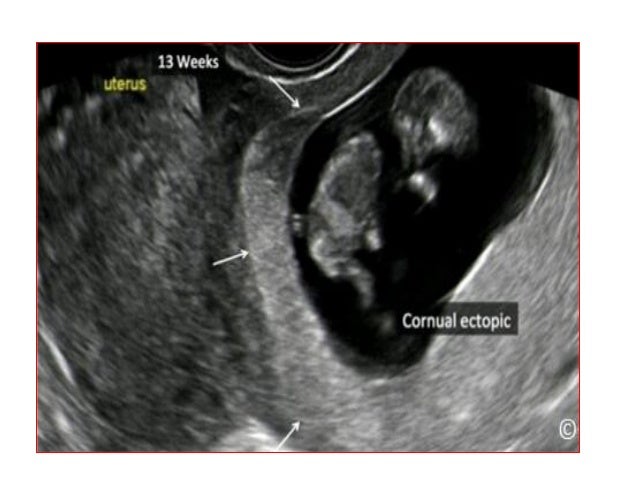 Weeks tilted uterus ultrasound 6 Tilted Uterus