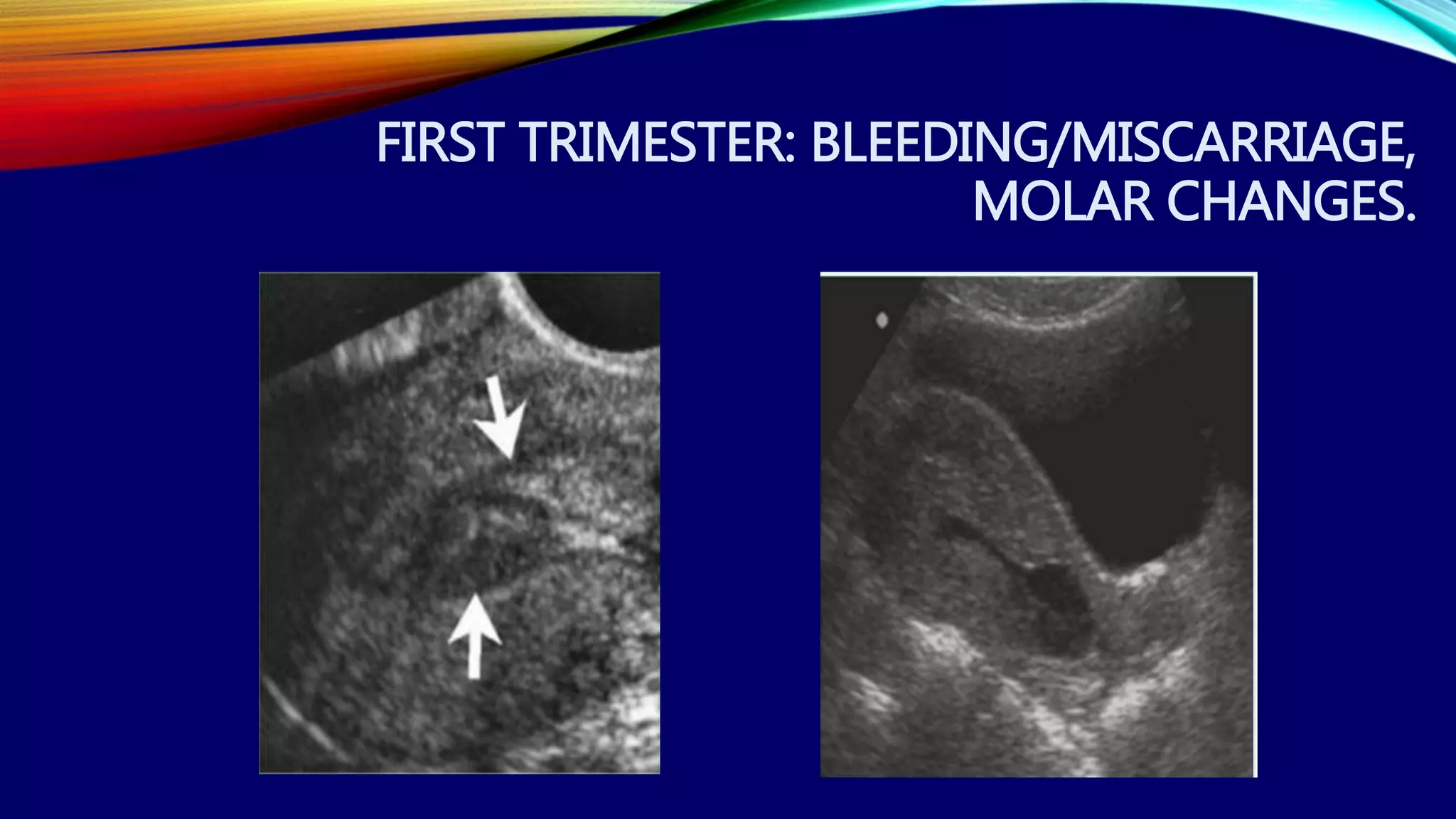 FIRST TRIMESTER: BLEEDING/MISCARRIAGE,
MOLAR CHANGES.
 
