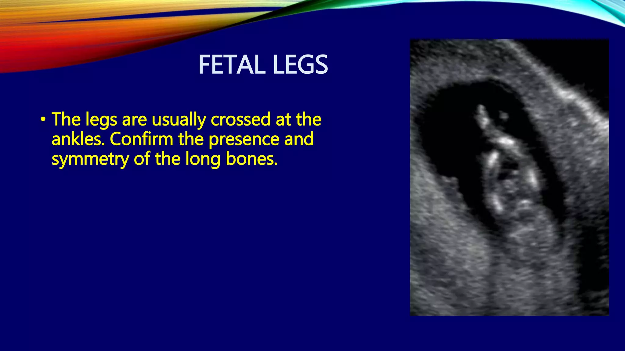FETAL LEGS
• The legs are usually crossed at the
ankles. Confirm the presence and
symmetry of the long bones.
 