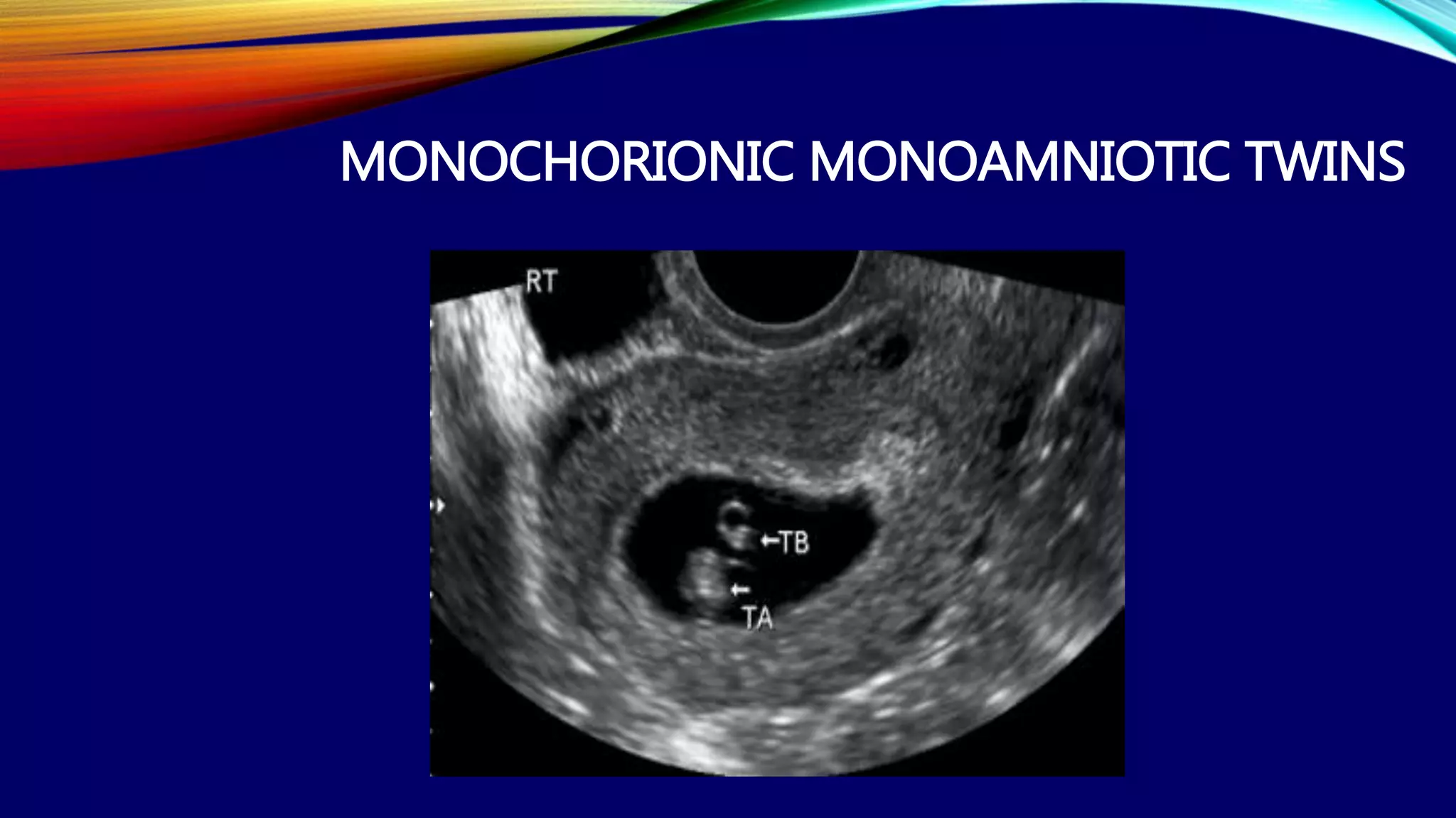 MONOCHORIONIC MONOAMNIOTIC TWINS
 