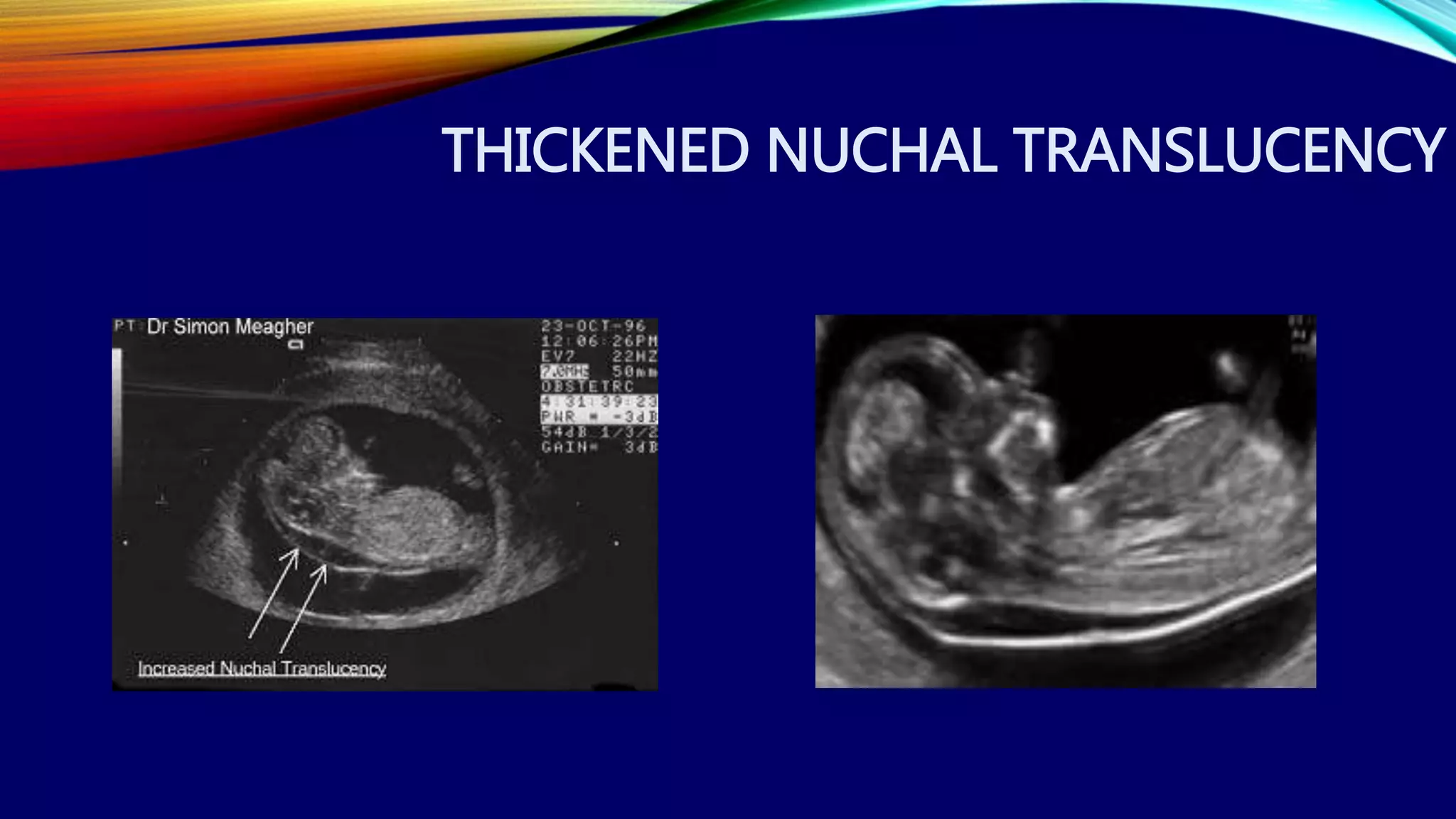THICKENED NUCHAL TRANSLUCENCY
 